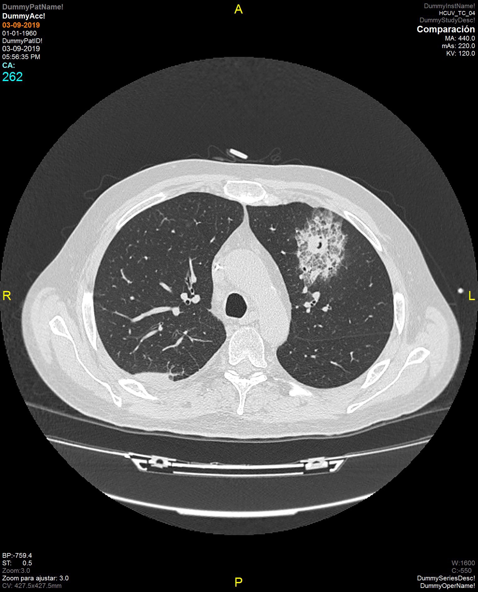 Neutropenia febril y aspergilosis invasiva — imagen de la pregunta 16 del examen MIR 2020