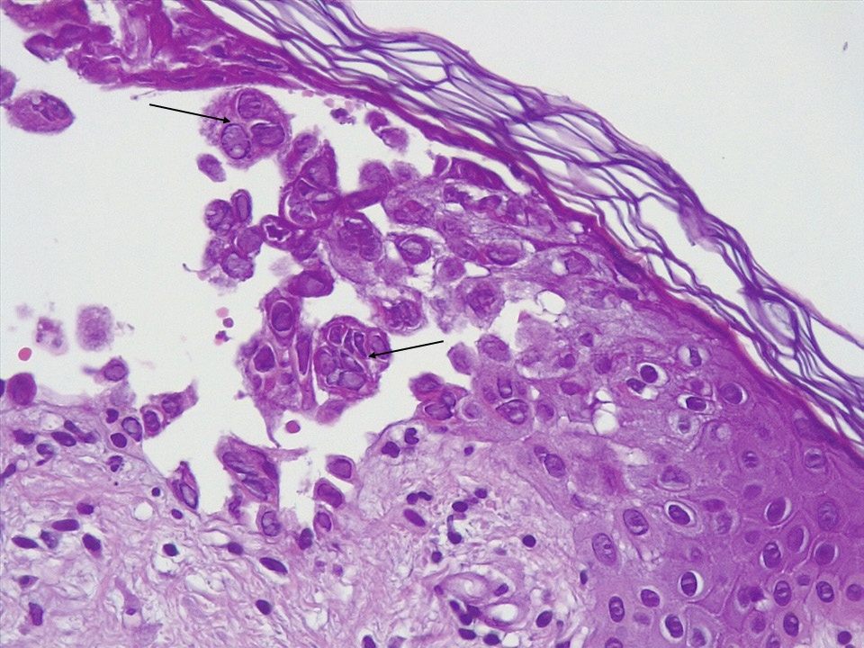 Infección cutánea por virus del herpes simple — imagen de la pregunta 4 del examen MIR 2020