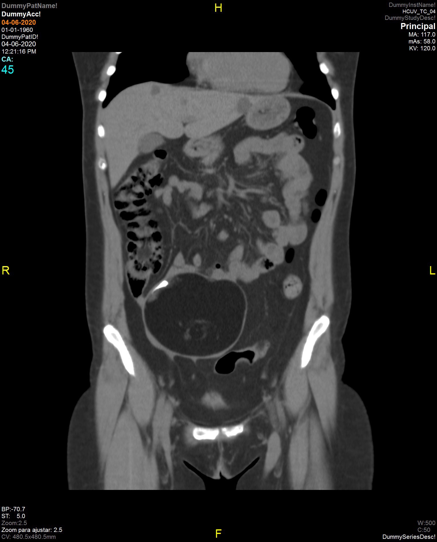 Teratoma ovárico maduro — imagen de la pregunta 15 del examen MIR 2020