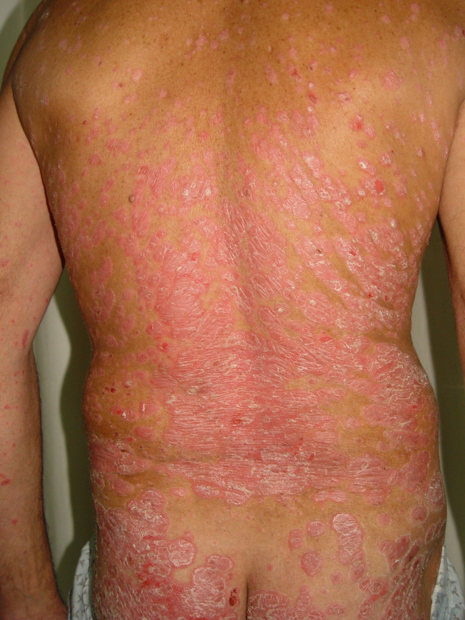 Psoriasis moderada a grave y tratamiento biológico — imagen de la pregunta 10 del examen MIR 2020