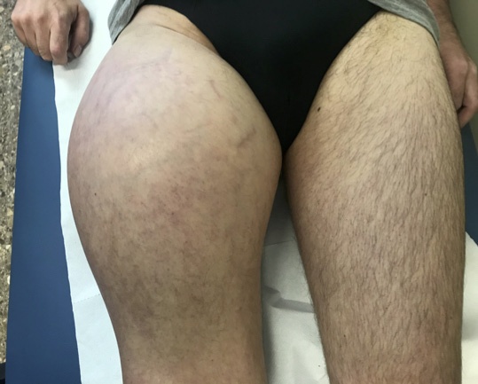 Tratamiento quirúrgico del sarcoma de partes blandas — imagen de la pregunta 21 del examen MIR 2020