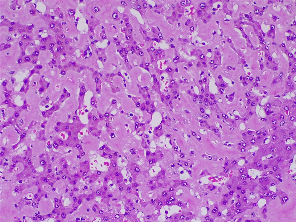 Amiloidosis hepática — imagen de la pregunta 6 del examen MIR 2020