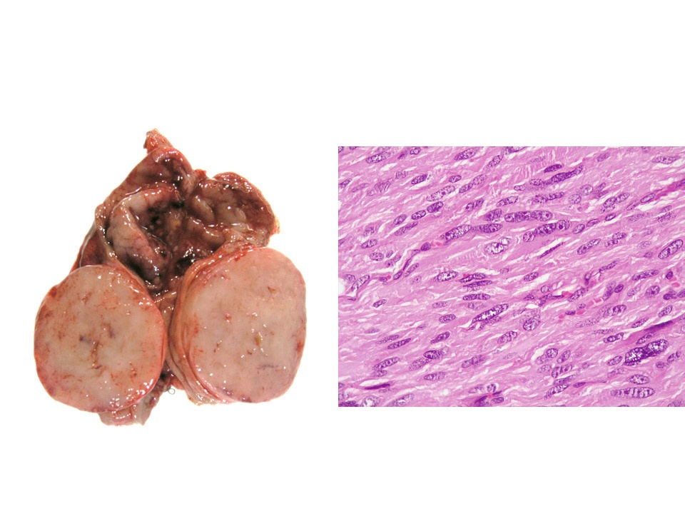 Tumor del estroma gastrointestinal — imagen de la pregunta 3 del examen MIR 2020