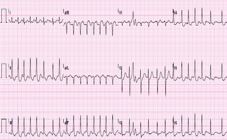 Fibrilación auricular en electrocardiograma — imagen de la pregunta 22 del examen MIR 2020