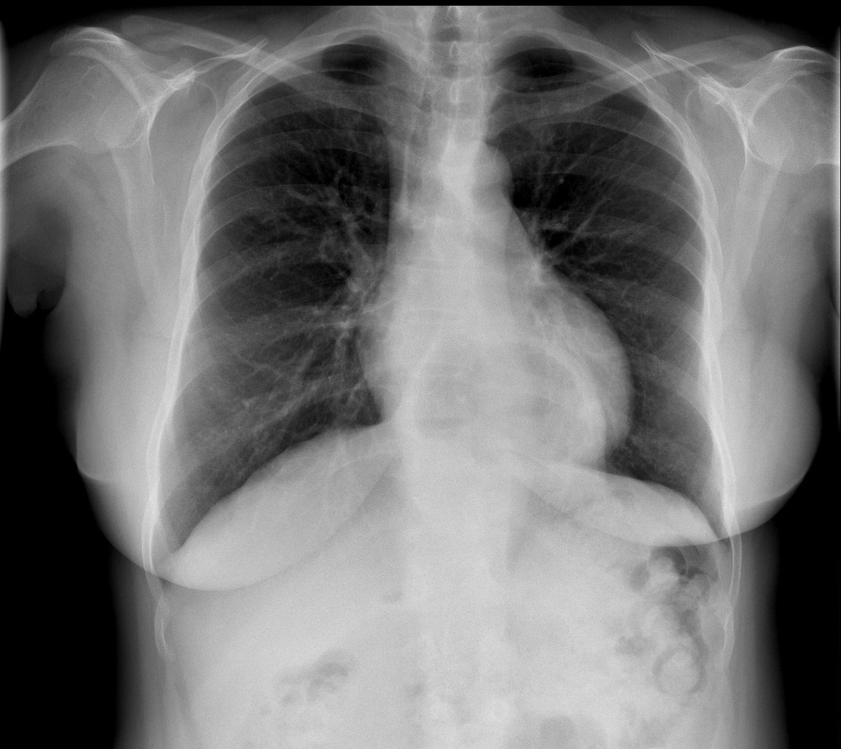 Hernia hiatal en radiografía de tórax — imagen de la pregunta 13 del examen MIR 2021