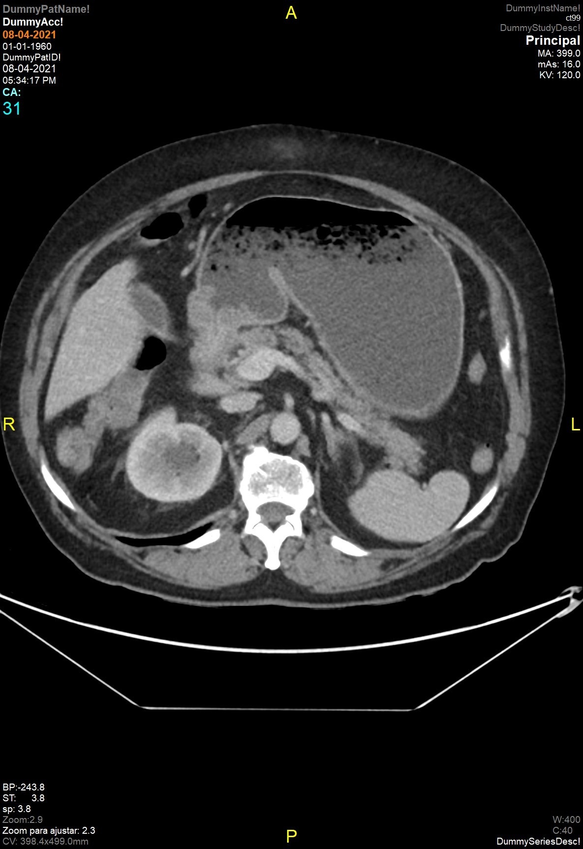 Obstrucción gástrica por neoplasia antropilórica — imagen de la pregunta 17 del examen MIR 2021