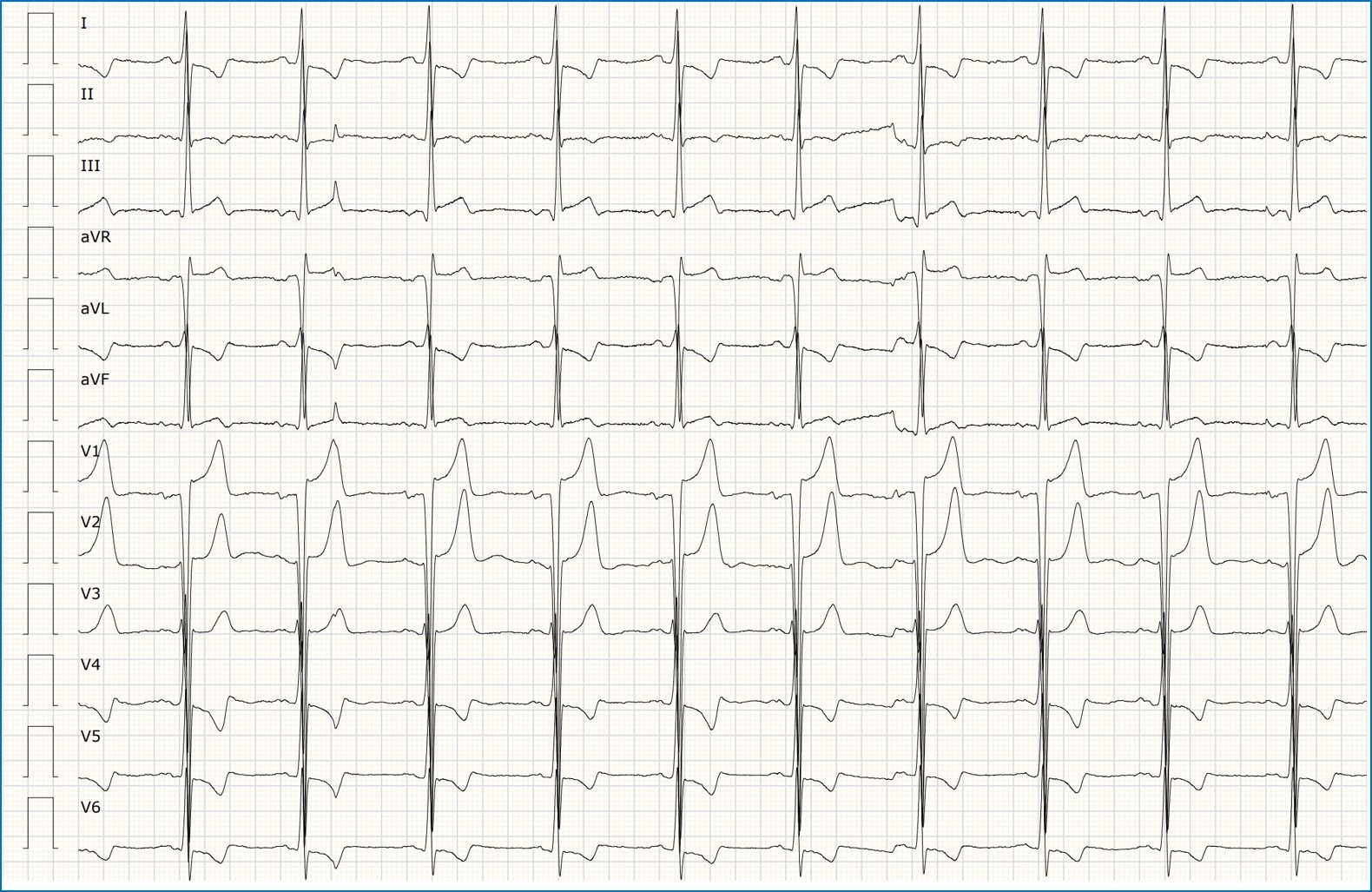 Miocardiopatía hipertrófica obstructiva — imagen de la pregunta 23 del examen MIR 2021