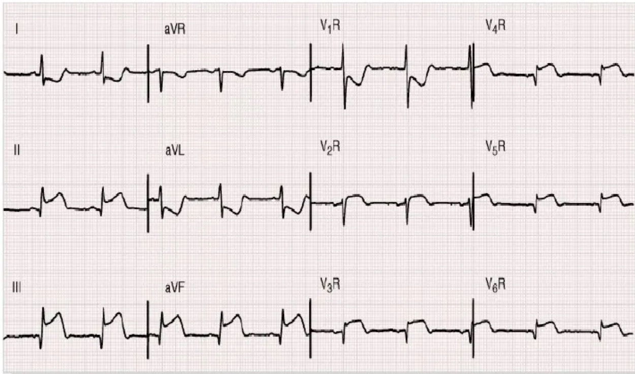 Infarto agudo de miocardio de ventrículo derecho — imagen de la pregunta 22 del examen MIR 2021