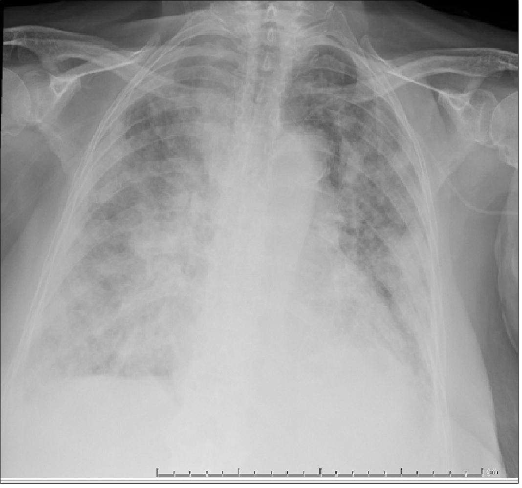 Endocarditis por SAMS con insuficiencia mitral aguda — imagen de la pregunta 20 del examen MIR 2021