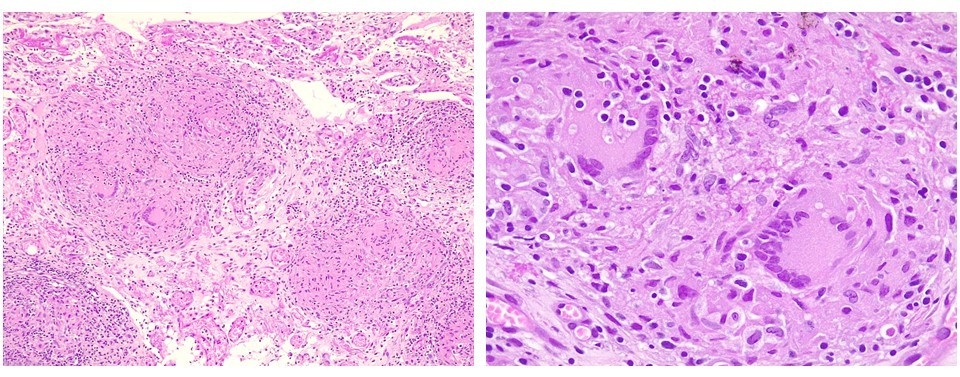 Mesotelioma pleural maligno — imagen de la pregunta 1 del examen MIR 2021