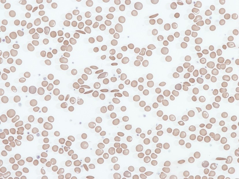 Anemia falciforme y crisis oclusivas vasculares — imagen de la pregunta 10 del examen MIR 2022