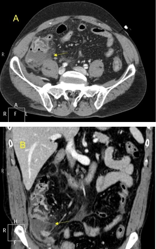Apendicitis aguda por imagen TC — imagen de la pregunta 21 del examen MIR 2022