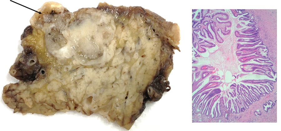 Neoplasia mucinosa quística de páncreas — imagen de la pregunta 15 del examen MIR 2022