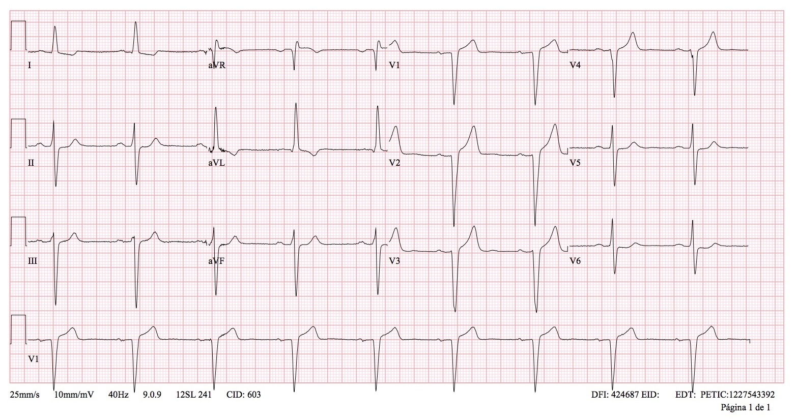 Miocardiopatía hipertrófica — imagen de la pregunta 5 del examen MIR 2022