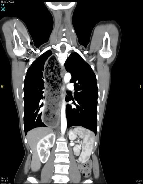 Acalasia esofágica — imagen de la pregunta 24 del examen MIR 2022