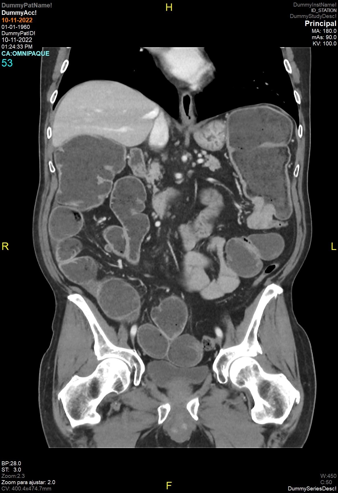 Obstrucción intestinal por neoplasia de colon — imagen de la pregunta 9 del examen MIR 2023