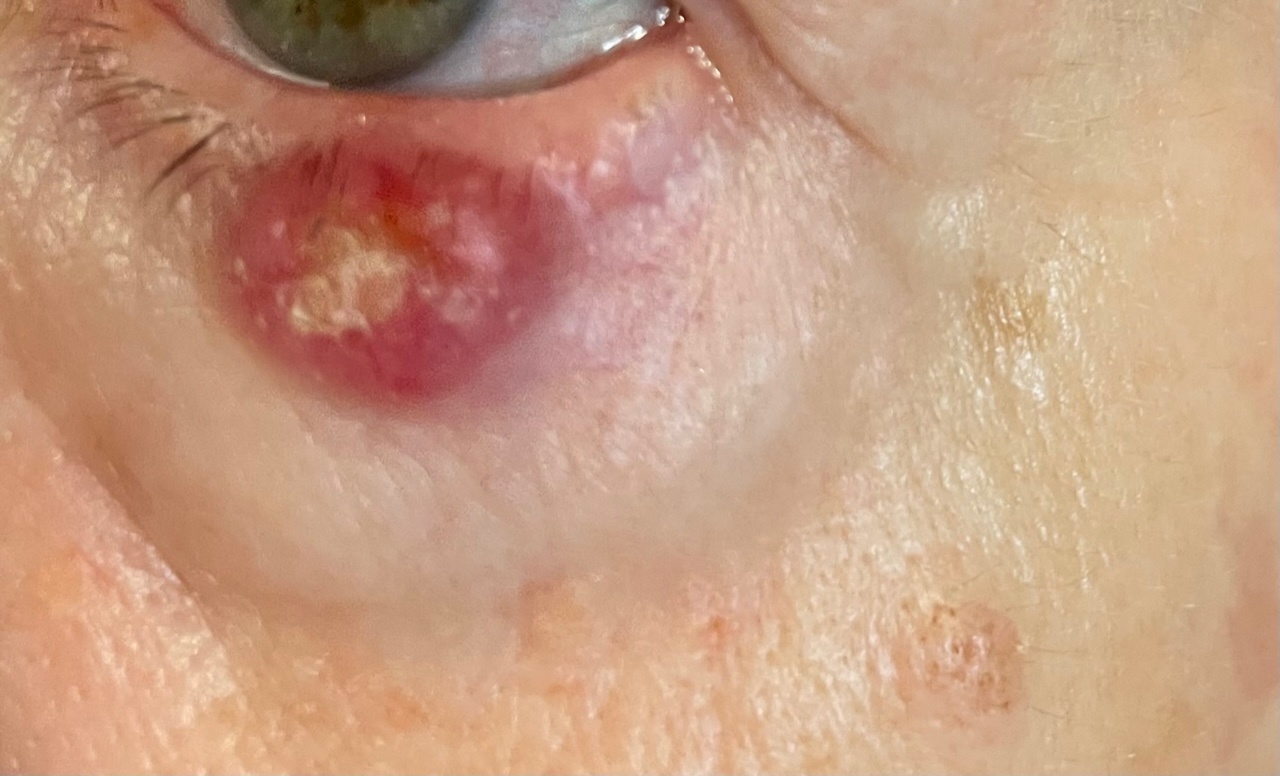 Carcinoma basocelular de párpado — imagen de la pregunta 23 del examen MIR 2023