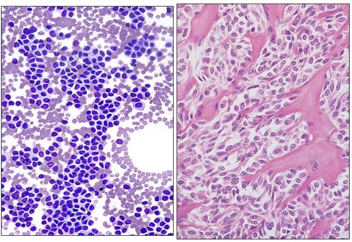 Carcinoma medular de tiroides — imagen de la pregunta 1 del examen MIR 2023