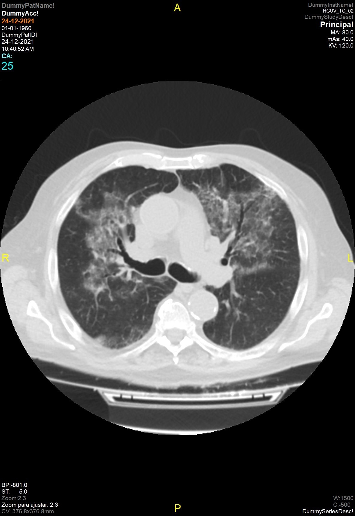 Neumonía por Pneumocystis jirovecii en trasplante — imagen de la pregunta 10 del examen MIR 2023