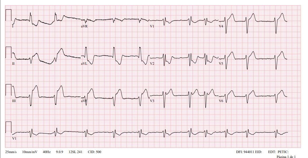 Bloqueo aurículo-ventricular de alto grado — imagen de la pregunta 13 del examen MIR 2023