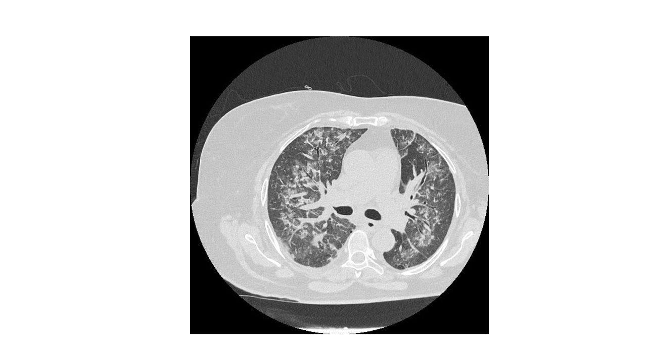 Fracaso renal agudo por glomerulonefritis y hemorragia alveolar — imagen de la pregunta 15 del examen MIR 2024