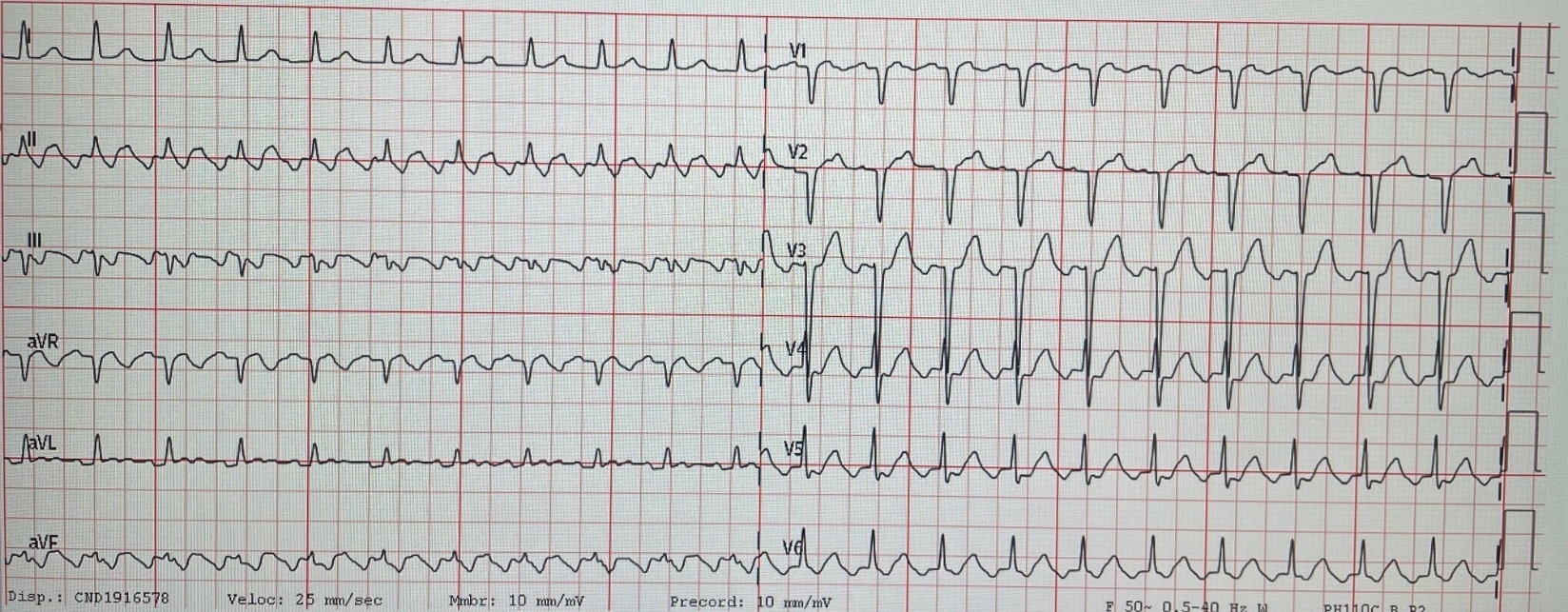 Diagnóstico electrocardiográfico de flutter auricular — imagen de la pregunta 13 del examen MIR 2024