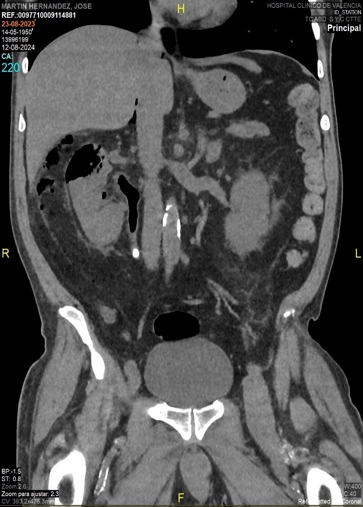Pielonefritis enfisematosa obstructiva — imagen de la pregunta 20 del examen MIR 2024