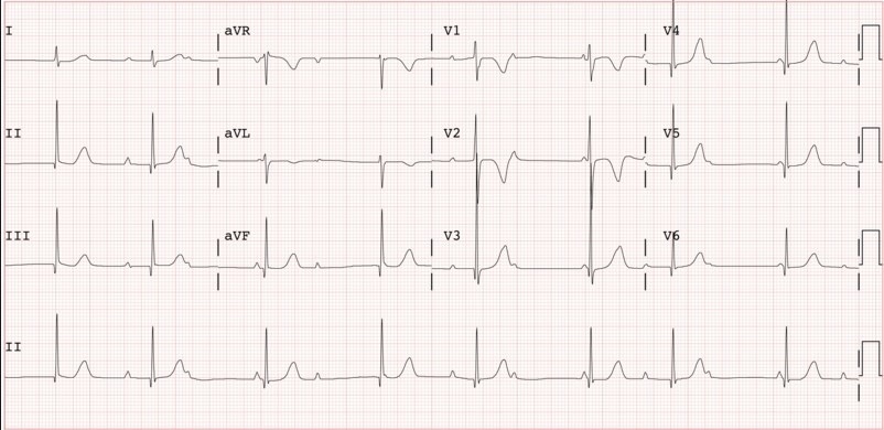 Bloqueo auriculoventricular de tercer grado — imagen de la pregunta 12 del examen MIR 2024