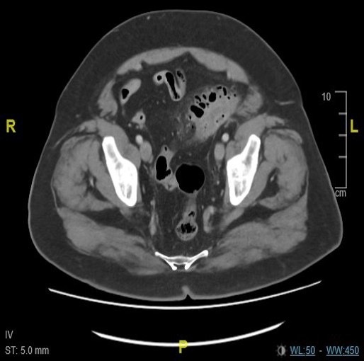 Diverticulitis aguda complicada — imagen de la pregunta 19 del examen MIR 2024