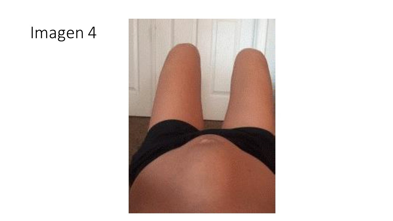 Diástasis de rectos abdominales — imagen de la pregunta 4 del examen MIR 2025