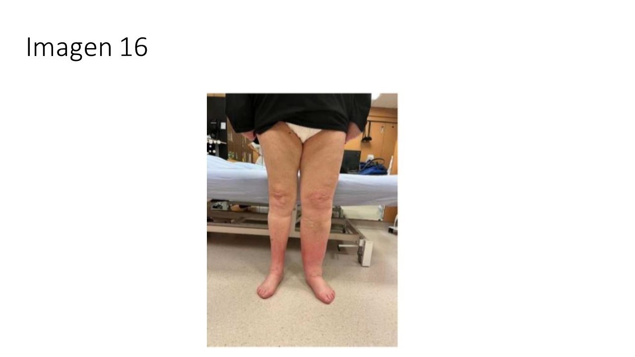 Linfedema diagnóstico y tratamiento — imagen de la pregunta 16 del examen MIR 2025