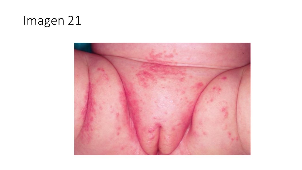 Dermatitis del pañal candidiásica — imagen de la pregunta 21 del examen MIR 2025