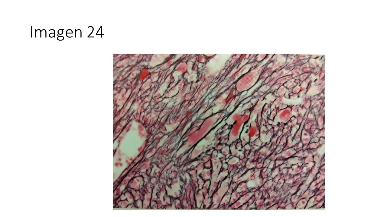 Mielofibrosis post trombocitemia esencial — imagen de la pregunta 24 del examen MIR 2025