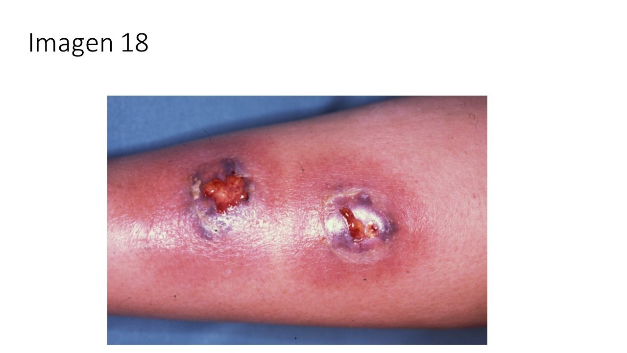 Úlcera pigoide y tratamiento con corticoides — imagen de la pregunta 18 del examen MIR 2025