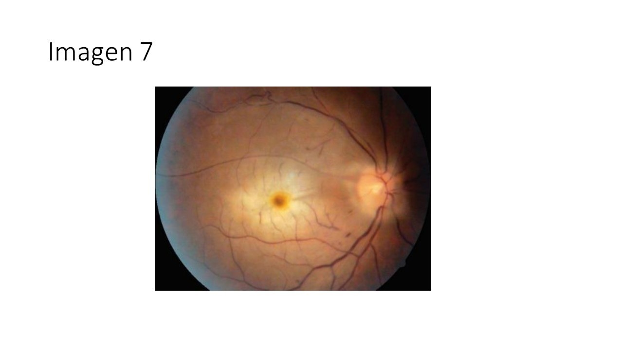 Mácula rojo cereza — imagen de la pregunta 7 del examen MIR 2025
