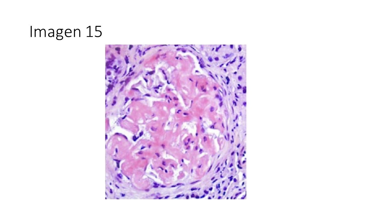 Amiloidosis sistémica y neuropatía autonómica — imagen de la pregunta 15 del examen MIR 2025