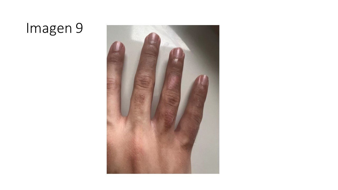 Dermatitis fitofototóxica por berloque — imagen de la pregunta 9 del examen MIR 2025