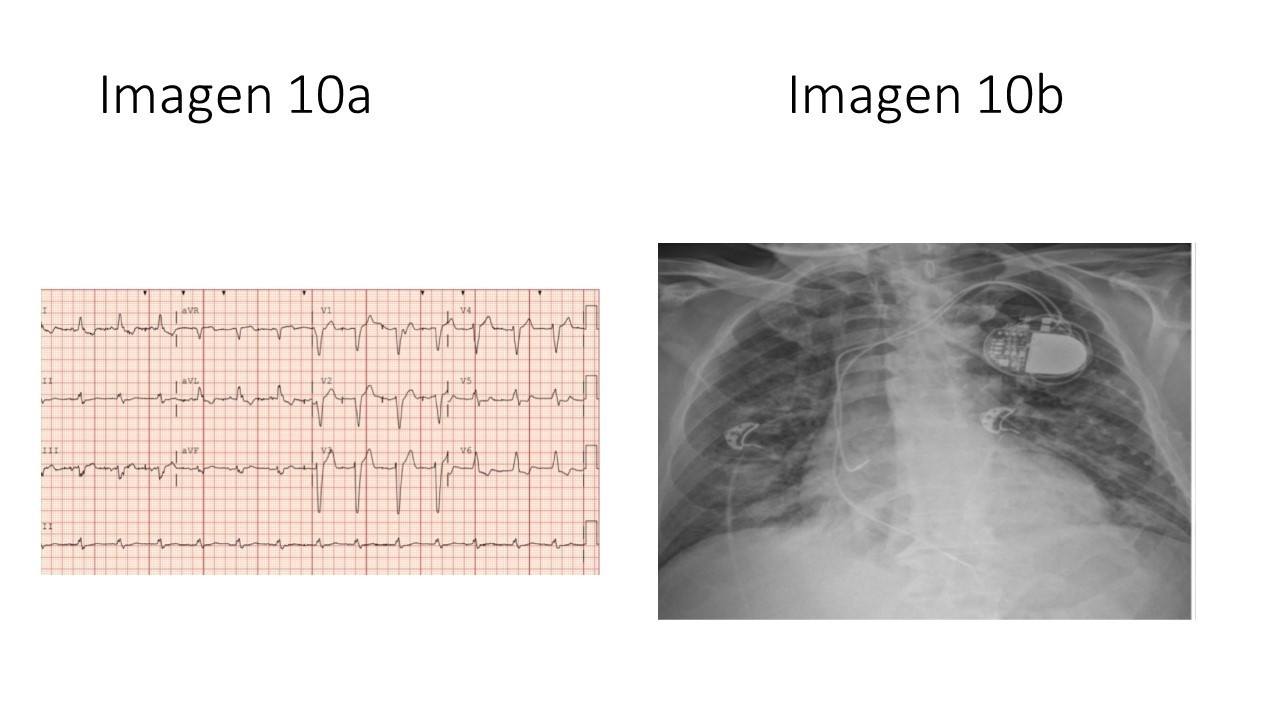 Tratamiento del shock cardiogénico — imagen de la pregunta 10 del examen MIR 2025