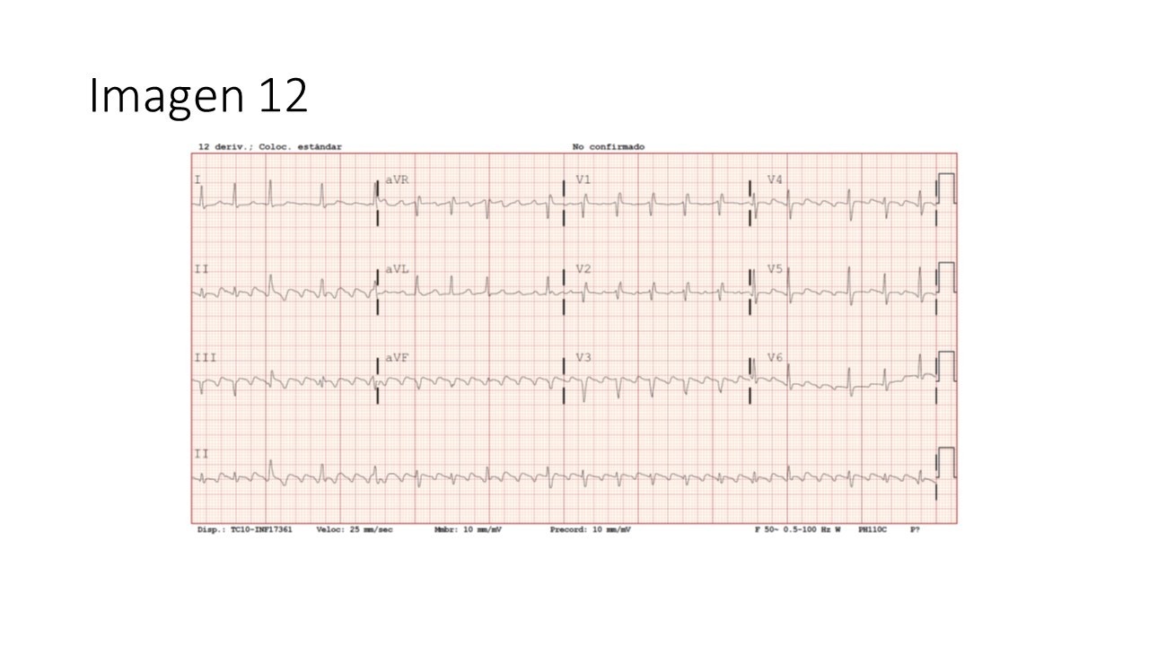 Flutter auricular común y ablación istmo cavotricuspídeo — imagen de la pregunta 11 del examen MIR 2025