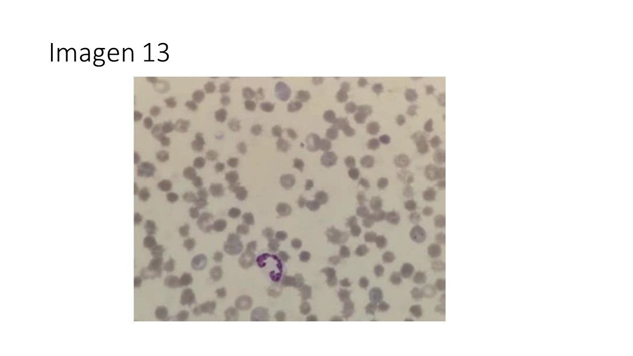 Cirrosis alcohólica y acantocitosis — imagen de la pregunta 13 del examen MIR 2025
