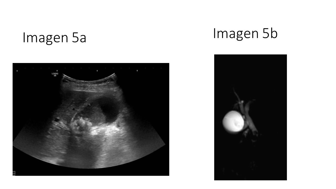 Coledocolitiasis y manejo con CPRE — imagen de la pregunta 5 del examen MIR 2025