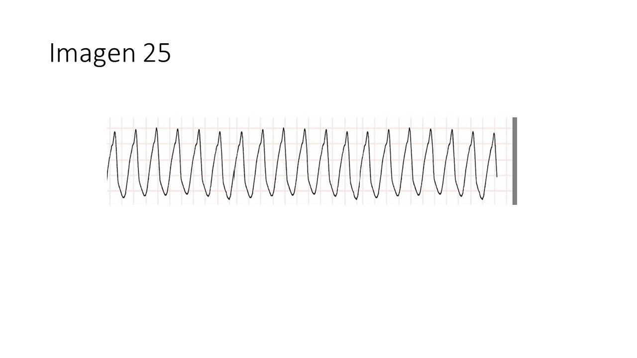 Fibrilación ventricular y desfibrilación — imagen de la pregunta 25 del examen MIR 2025