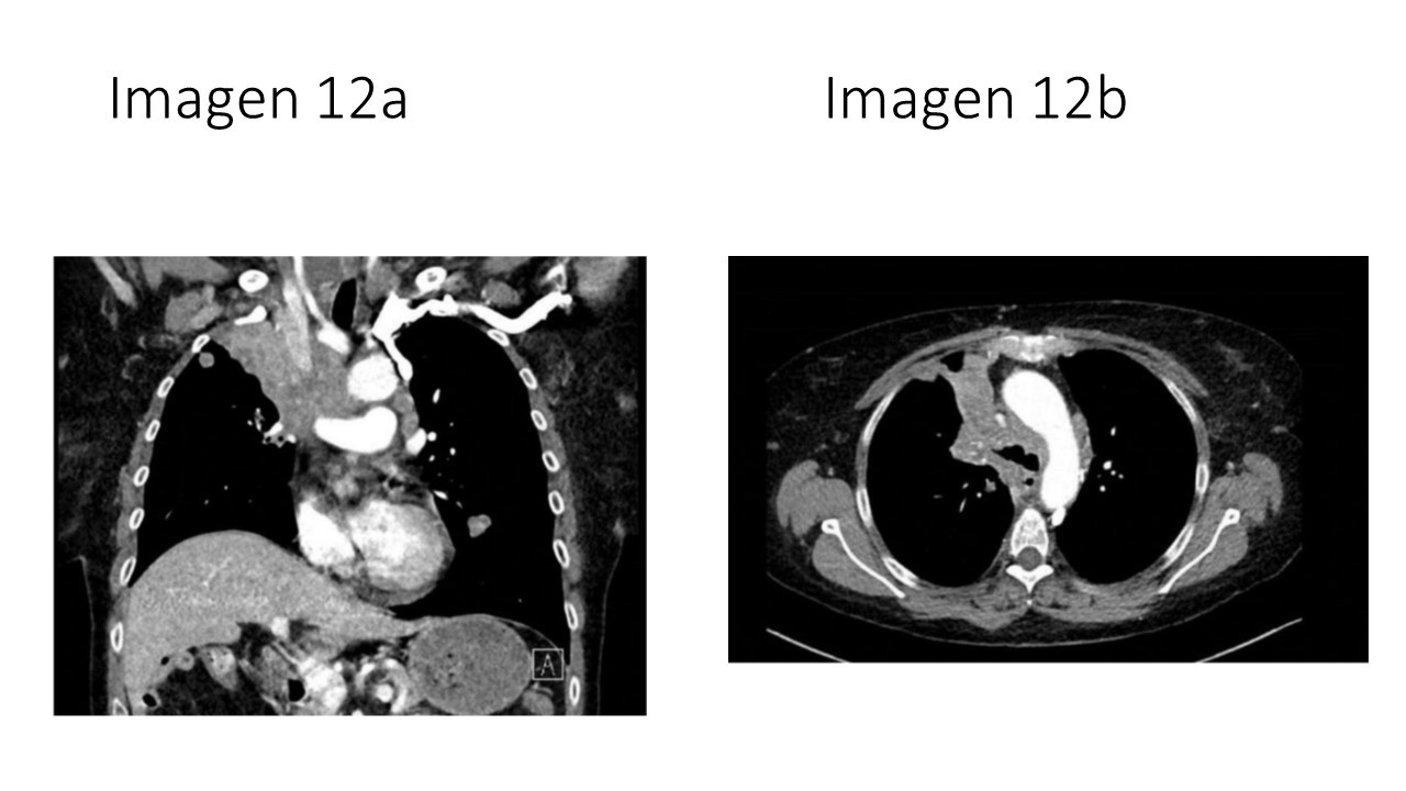 Síndrome de vena cava superior por carcinoma microcítico — imagen de la pregunta 12 del examen MIR 2025