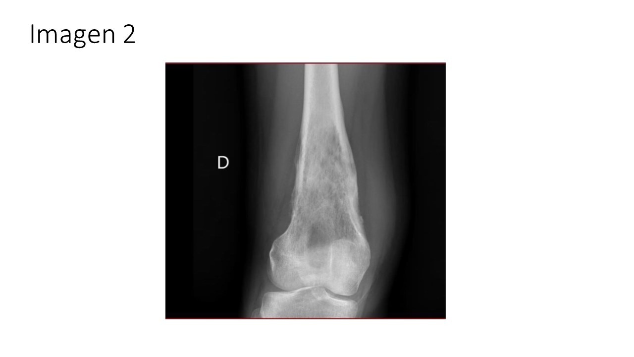 Tumor óseo maligno osteosarcoma — imagen de la pregunta 1 del examen MIR 2025