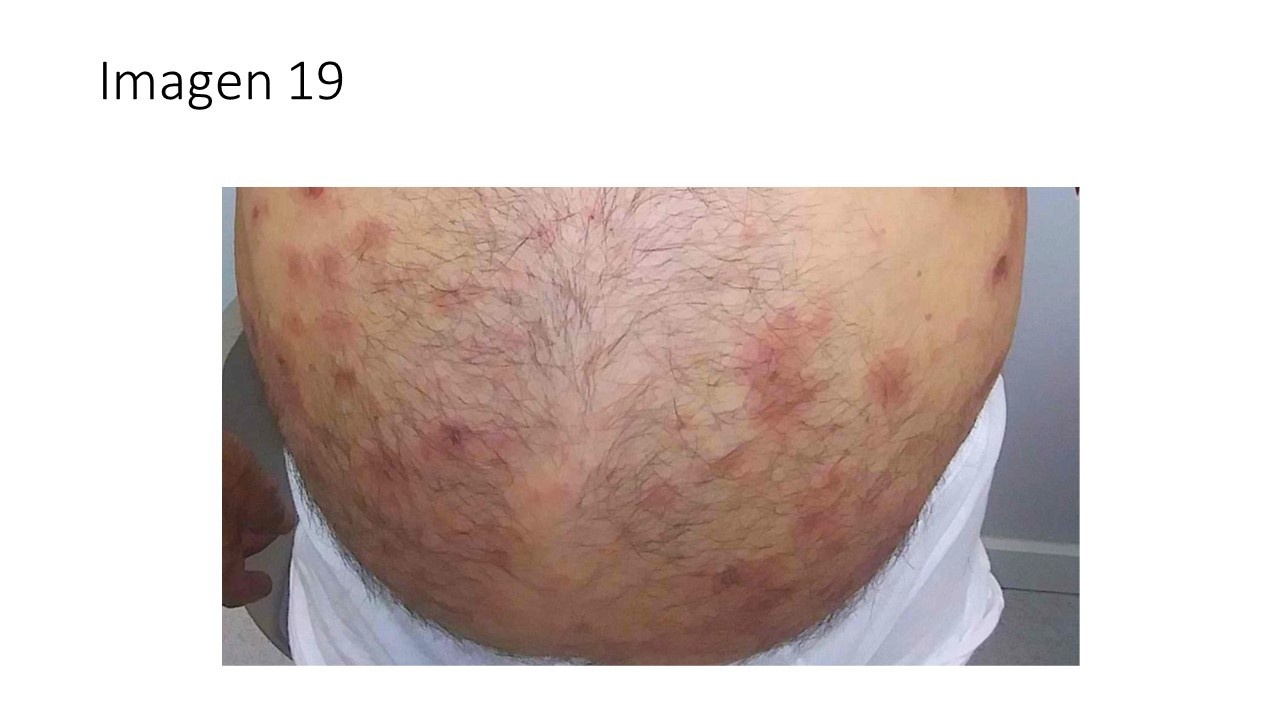 Penfigoide ampolloso diagnóstico y tratamiento — imagen de la pregunta 19 del examen MIR 2025