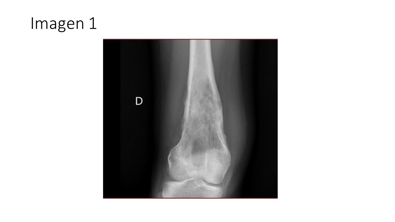 Osteosarcoma: hallazgos radiográficos y diagnóstico diferencial — imagen de la pregunta 2 del examen MIR 2025