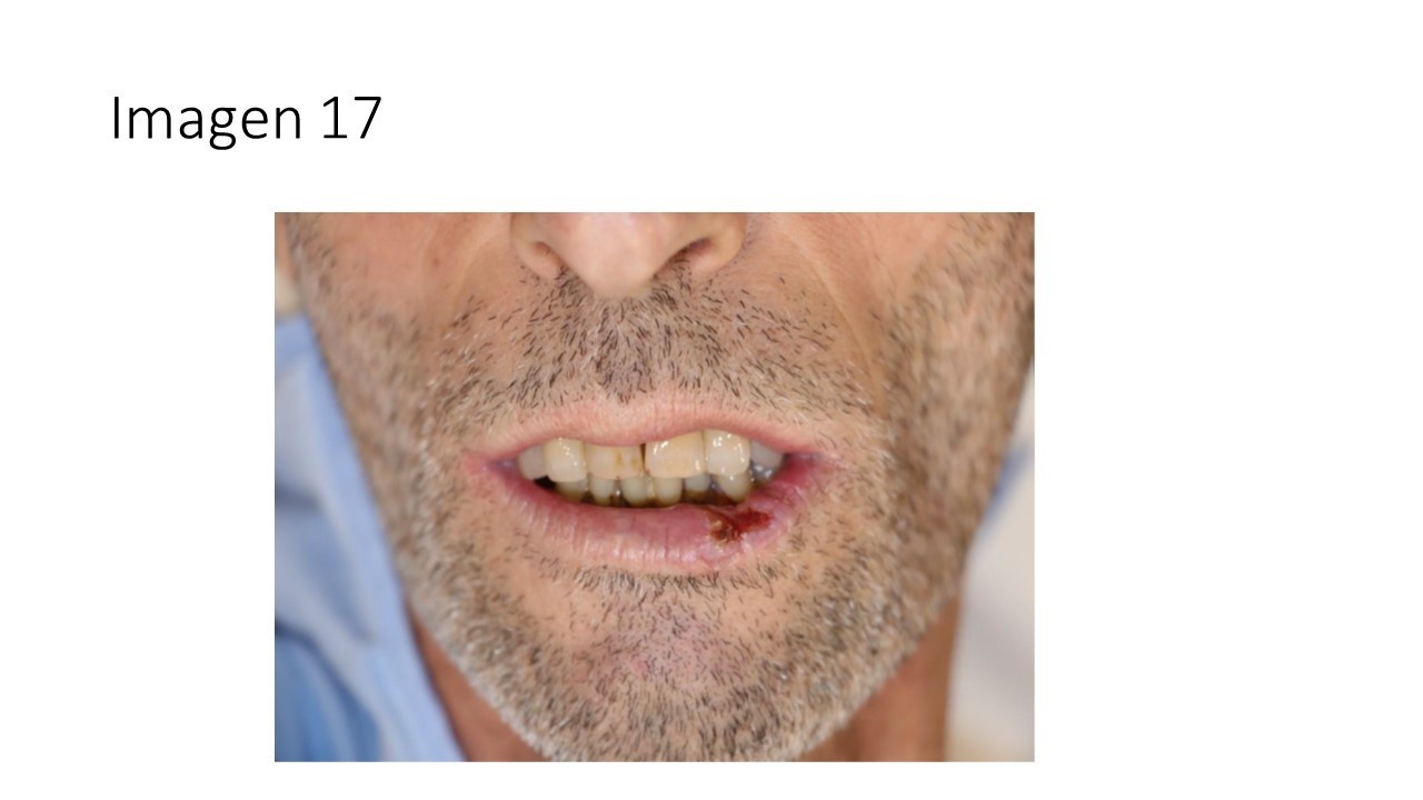 Queilitis actínica y carcinoma escamoso labial — imagen de la pregunta 17 del examen MIR 2025
