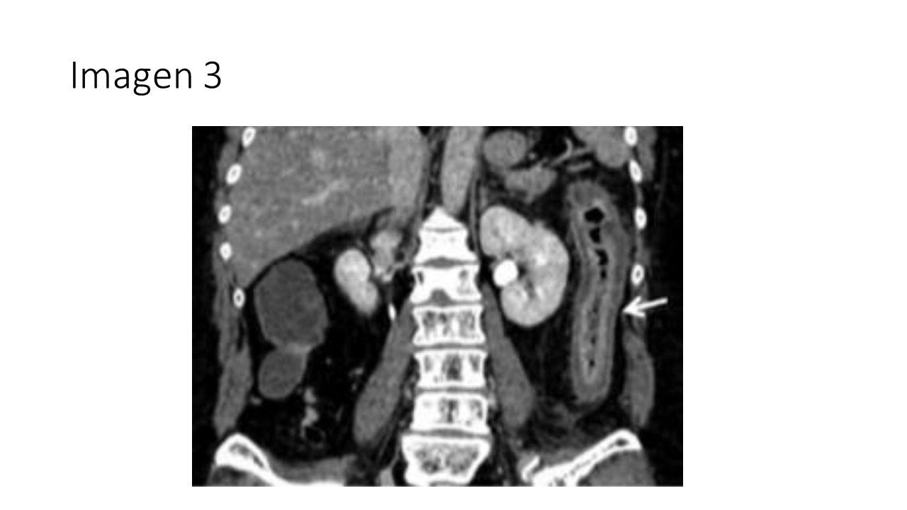 Colitis isquémica postoperatoria — imagen de la pregunta 3 del examen MIR 2025